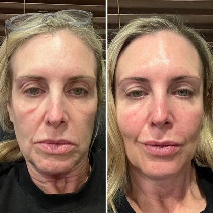 Auralume™ Skin Therapy Mask